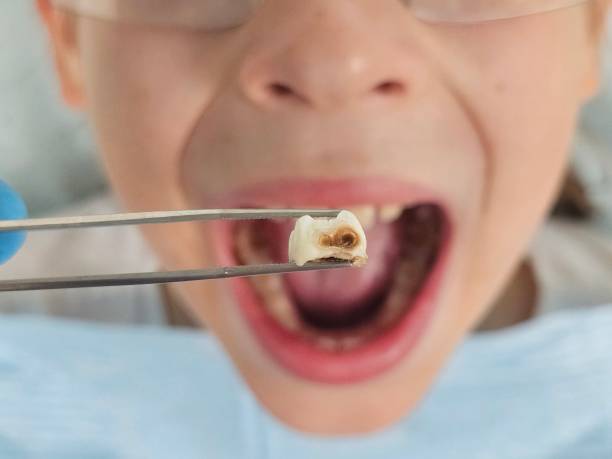 Best Emergency Dental Care for Broken or Chipped Teeth in Whiting, WI